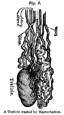 A Testicle wasted by Masturabation.